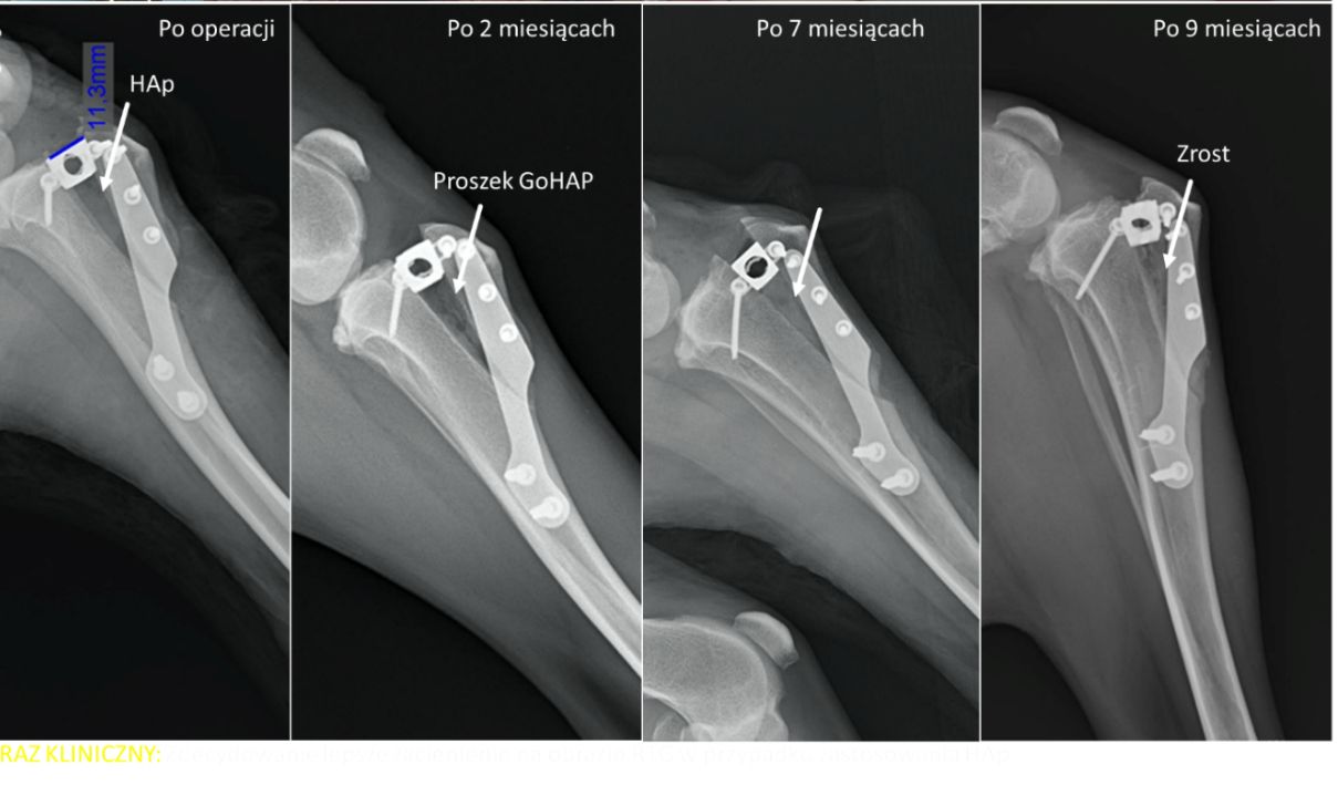 Obrazy rentgenowskie stabilizacji stawu kolanowego po zerwaniu więzadła